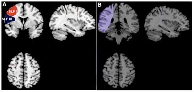 Language function of the superior longitudinal fasciculus in patients with arteriovenous malformation as evidenced by automatic fiber quantification
